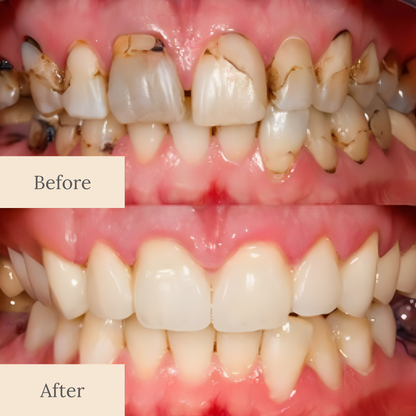 Amelaine Dental Cavity Healing Tooth Armor